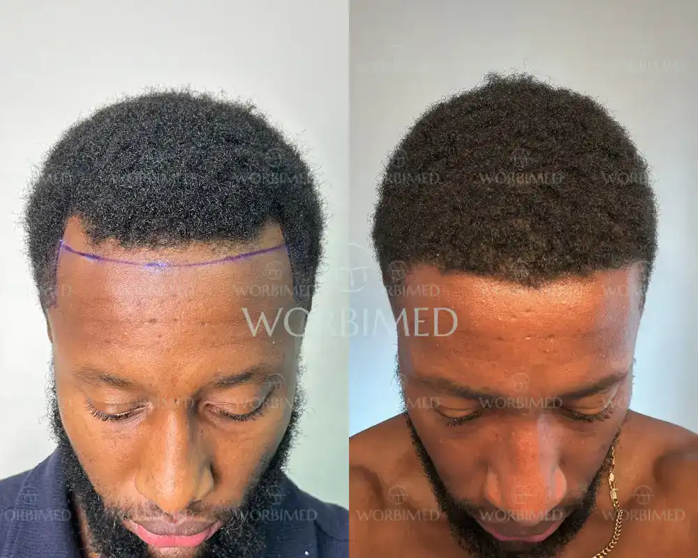 afro hair transplant turkey before and after