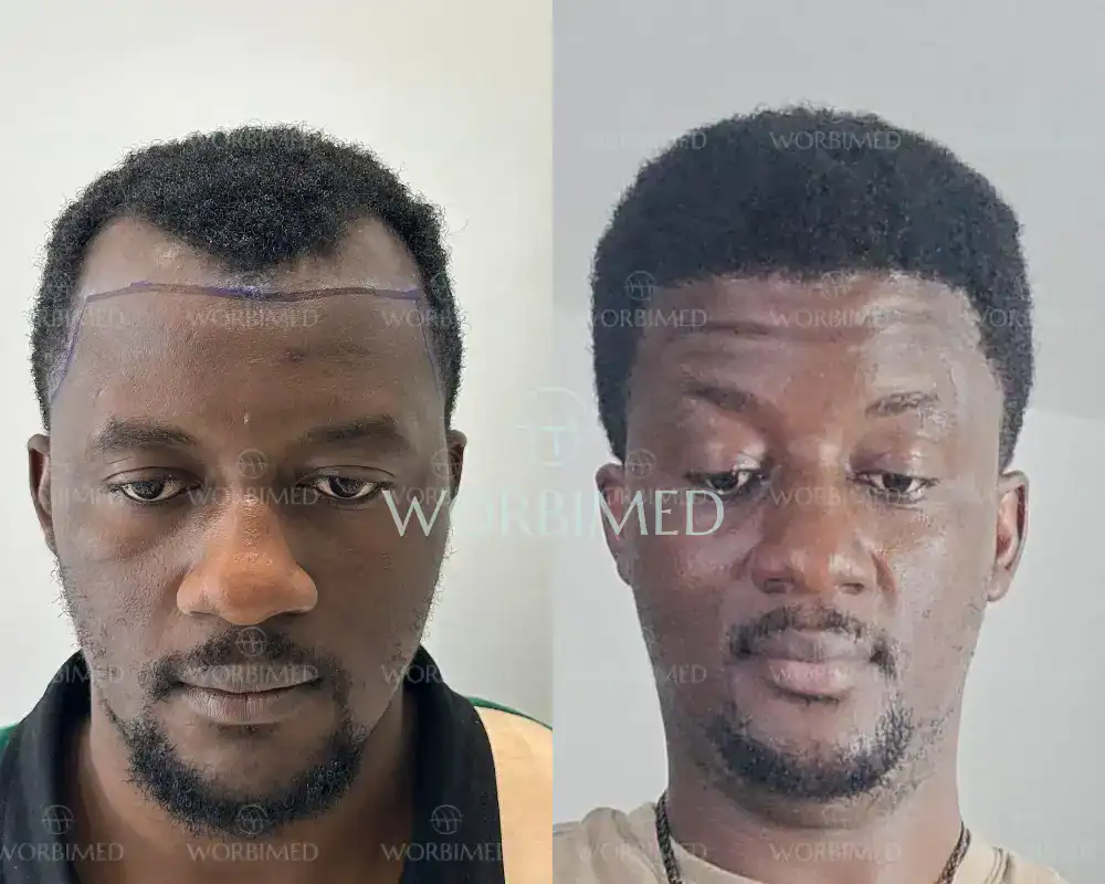 afro hair transplant turkey