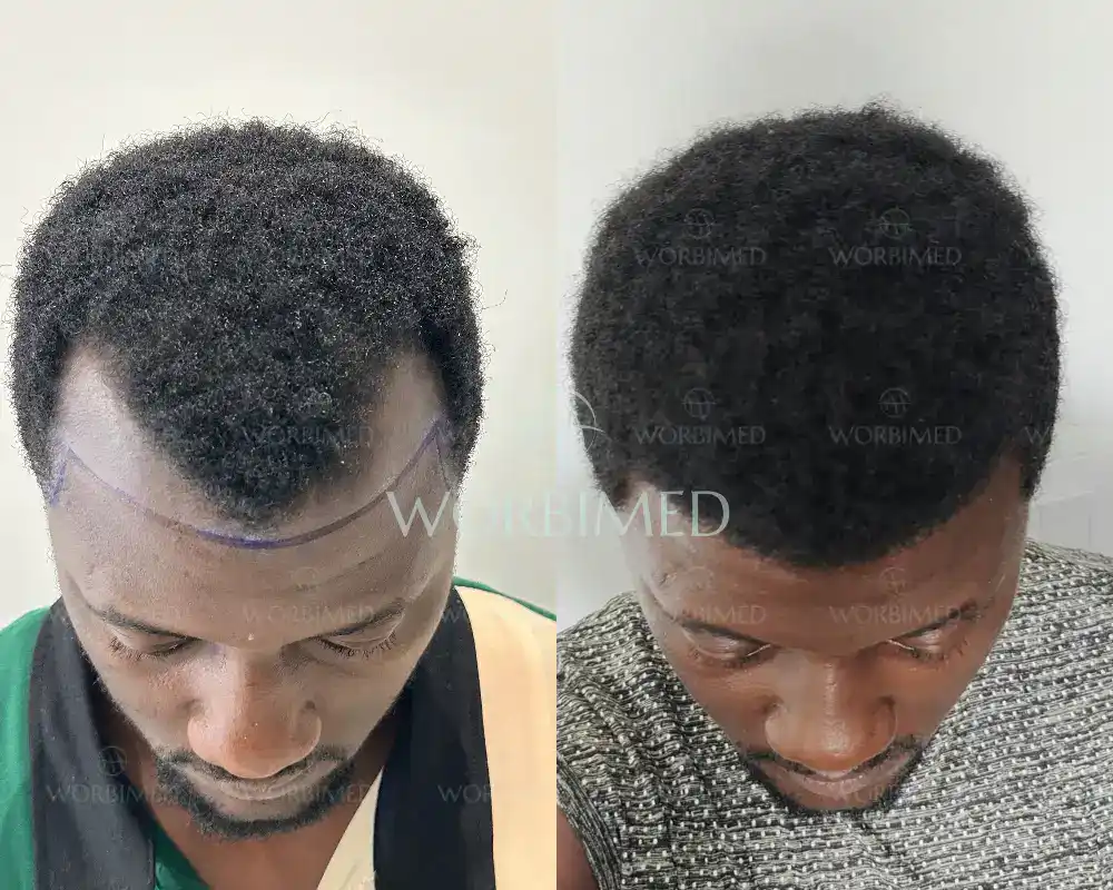 afro hair transplant before and after