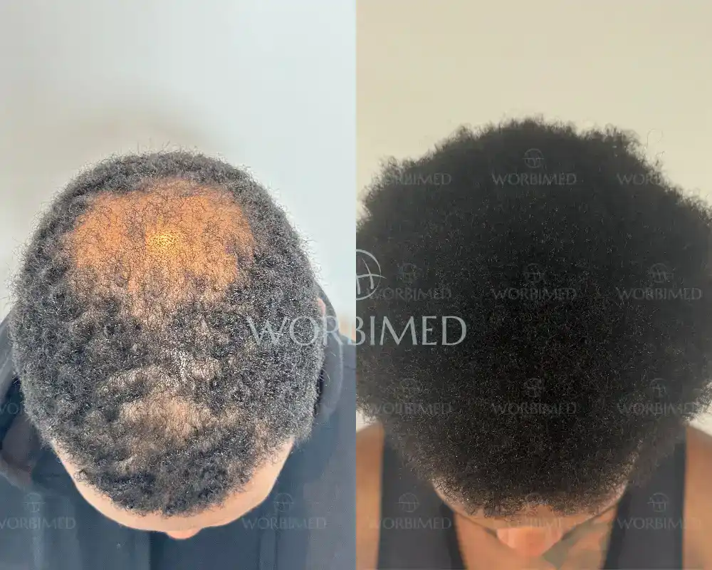 afro hair transplant crown density result