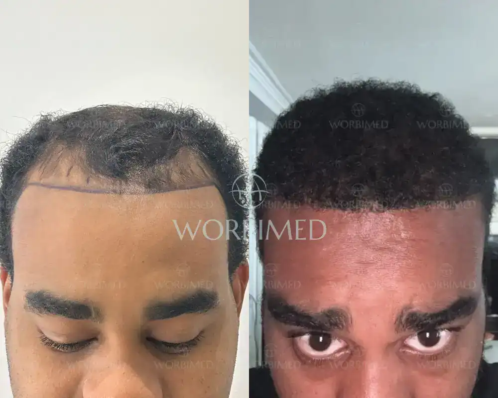 afro hair transplant for men