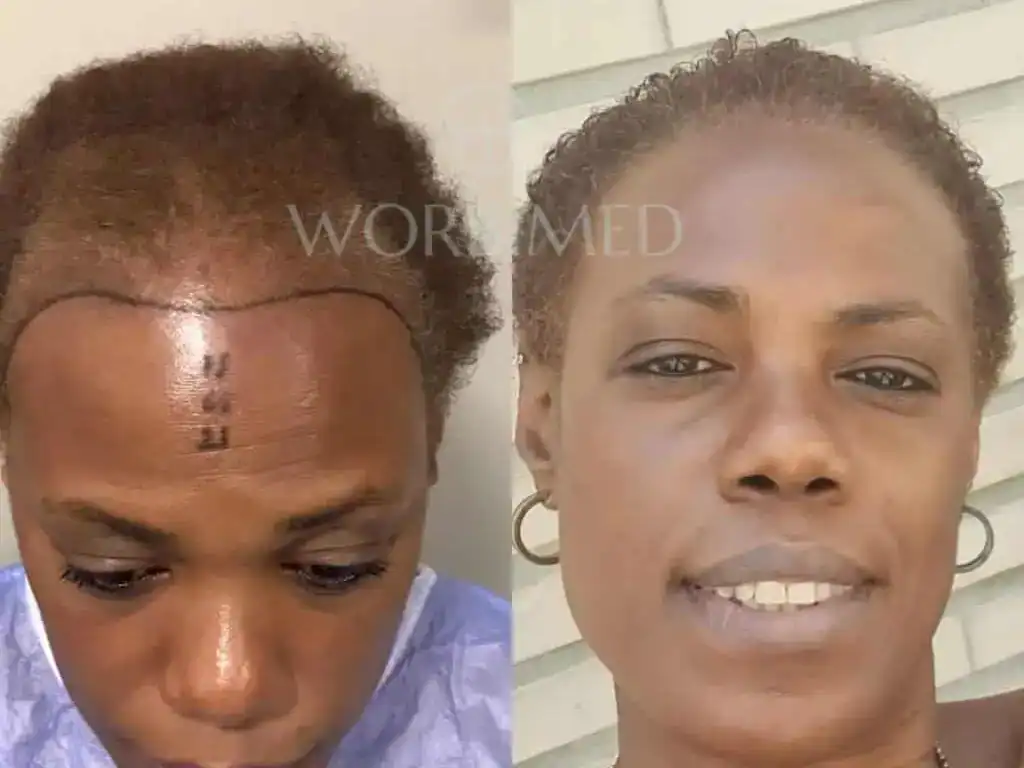 Afro hair transplant for women