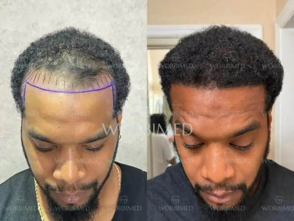 Afro hair transplant in Turkey