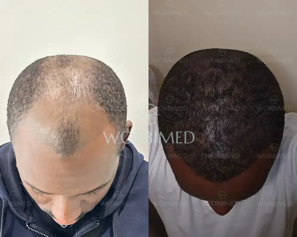 afro hair transplant turkey cost