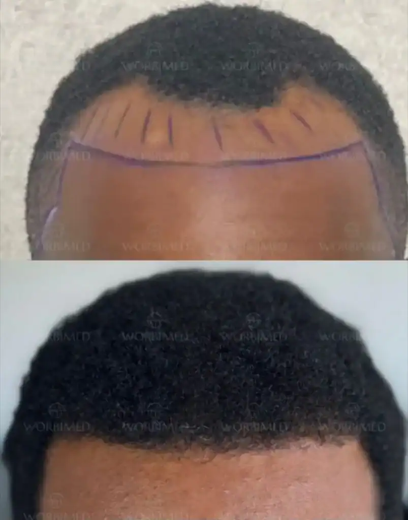 afro hair transplant