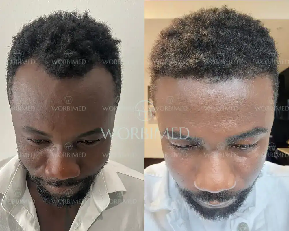 black male hair transplant result
