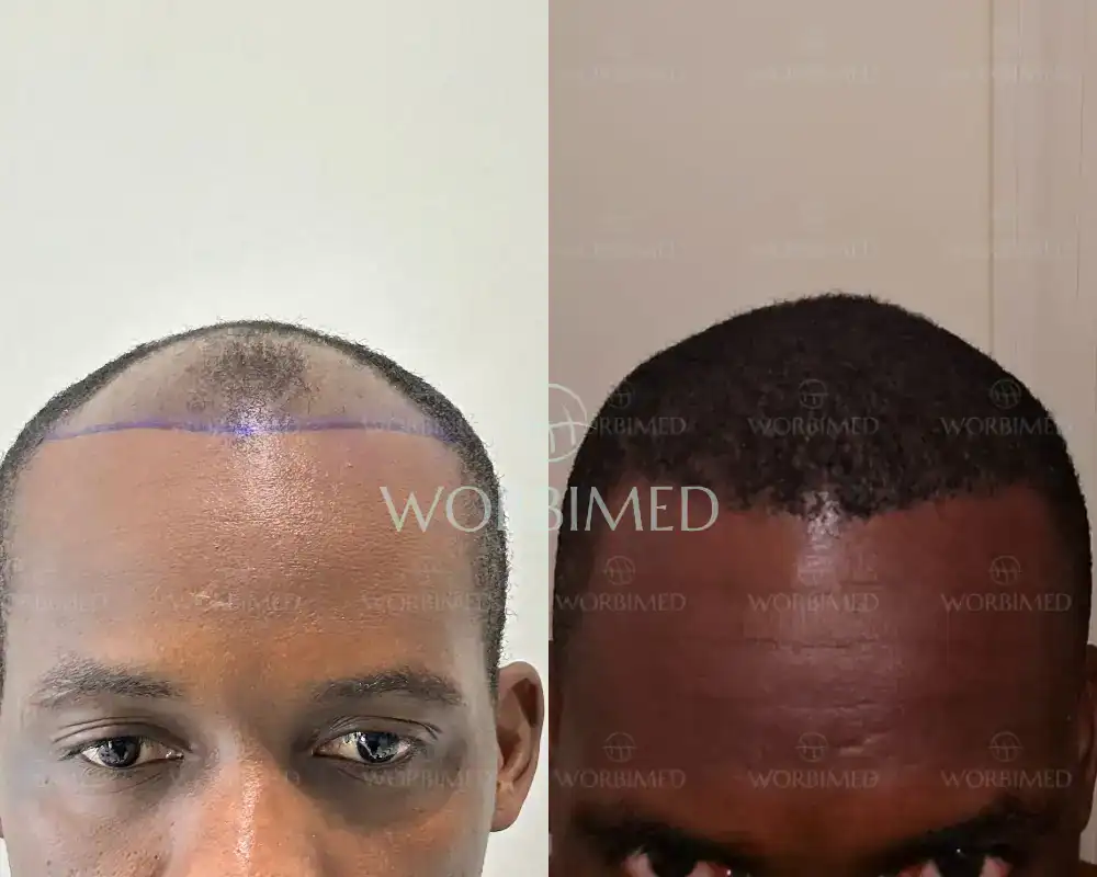 black men hair transplant turkey