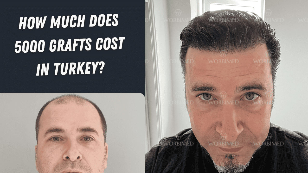 How Much Does 5000 Grafts Cost in Turkey?