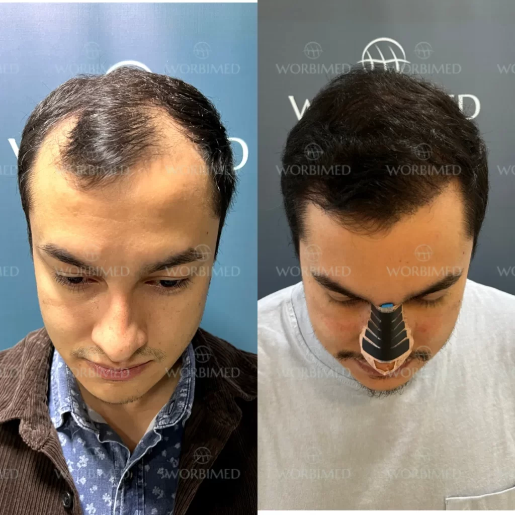 Hair Transplant Turkey Before and After