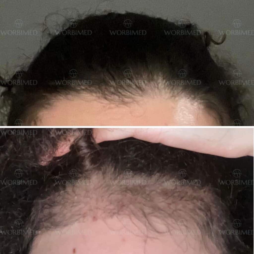 Пересадка волос для женщин в Турции