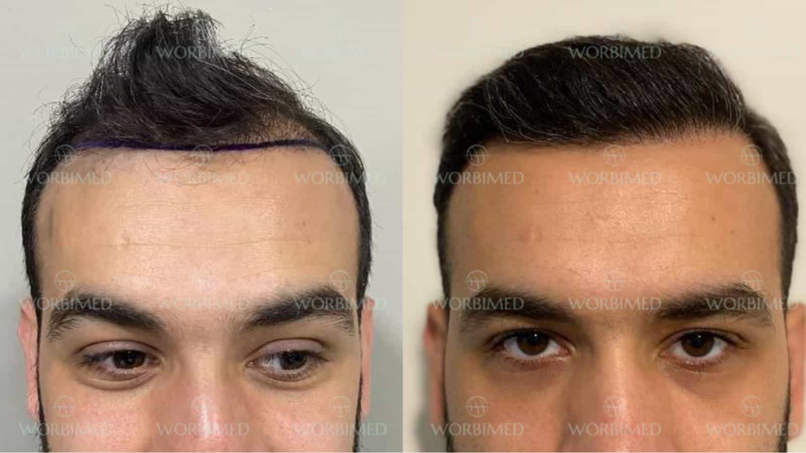 2500 grafts hair transplant before and after result