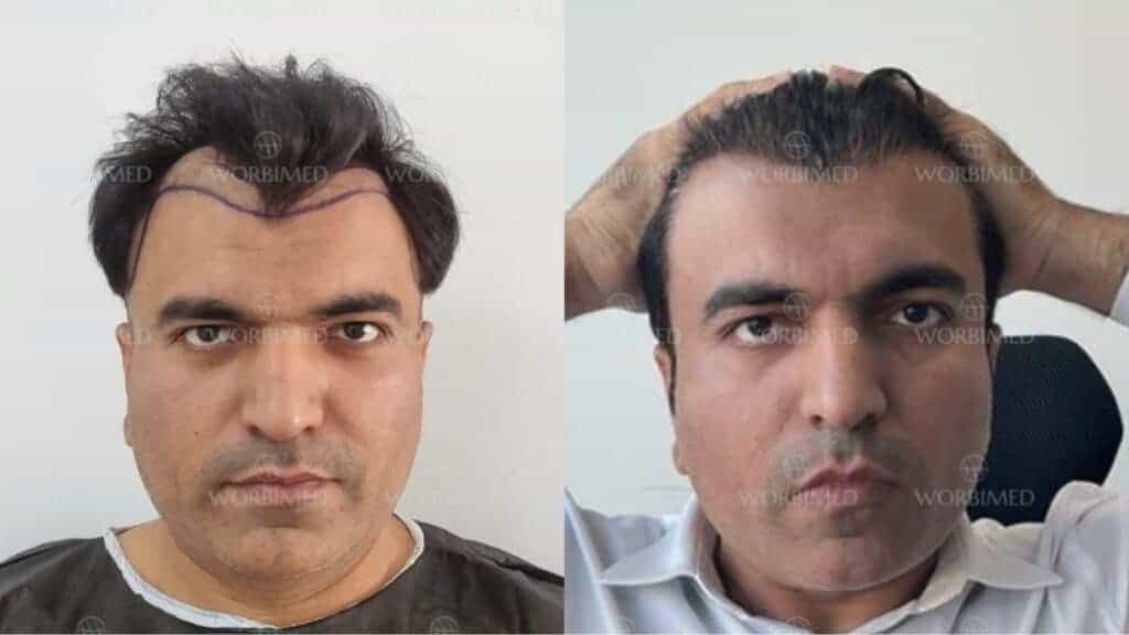 2500 grafts hair transplant before and after