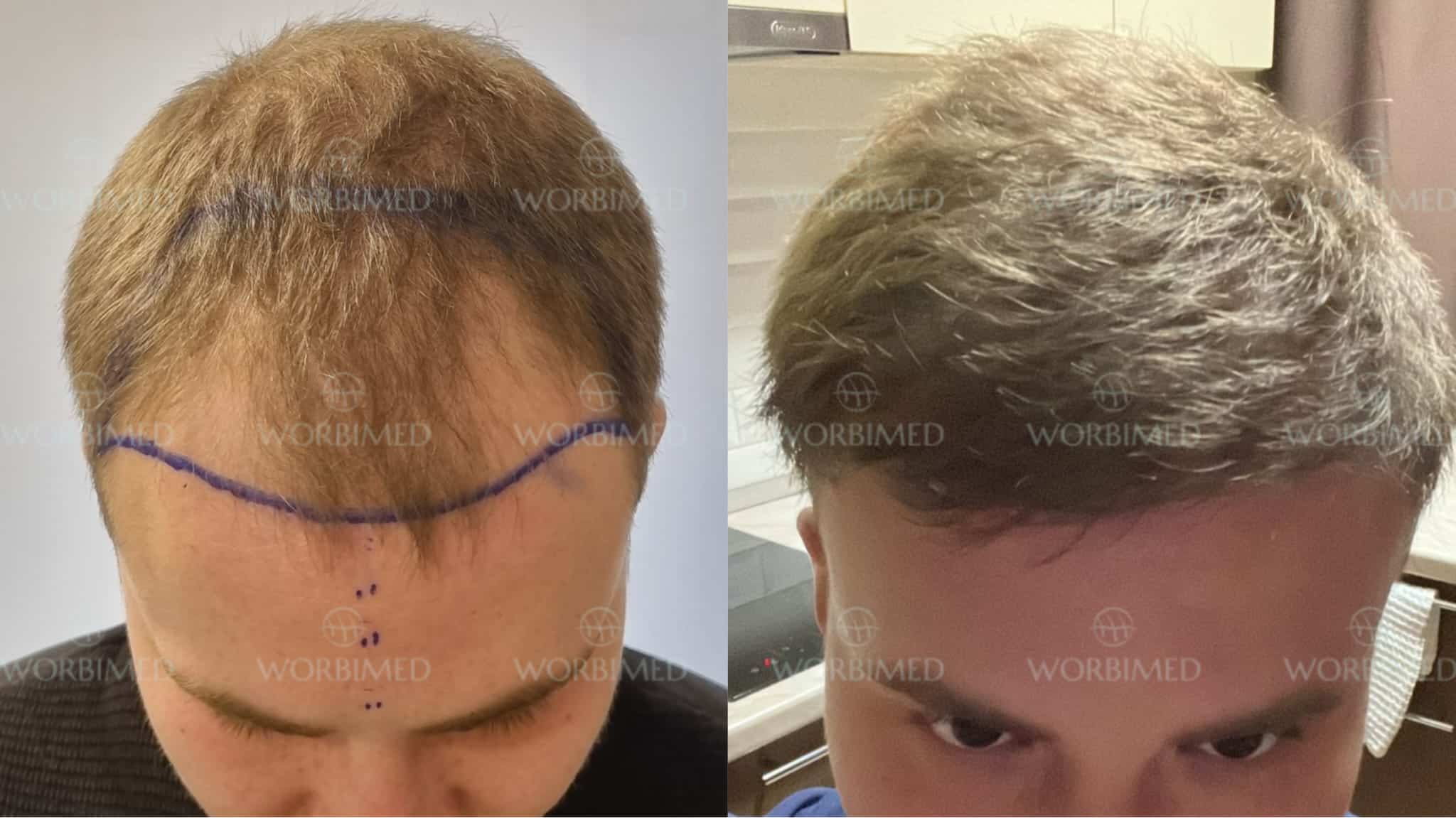 3500 grafts before and after