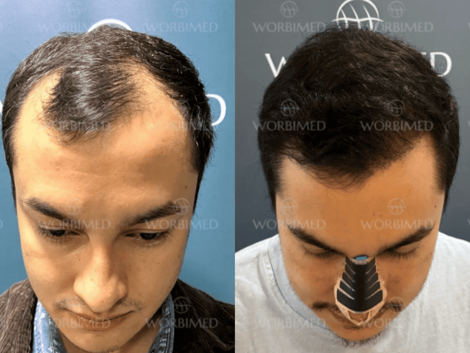 Пересадка волос 4000 графтов до и после