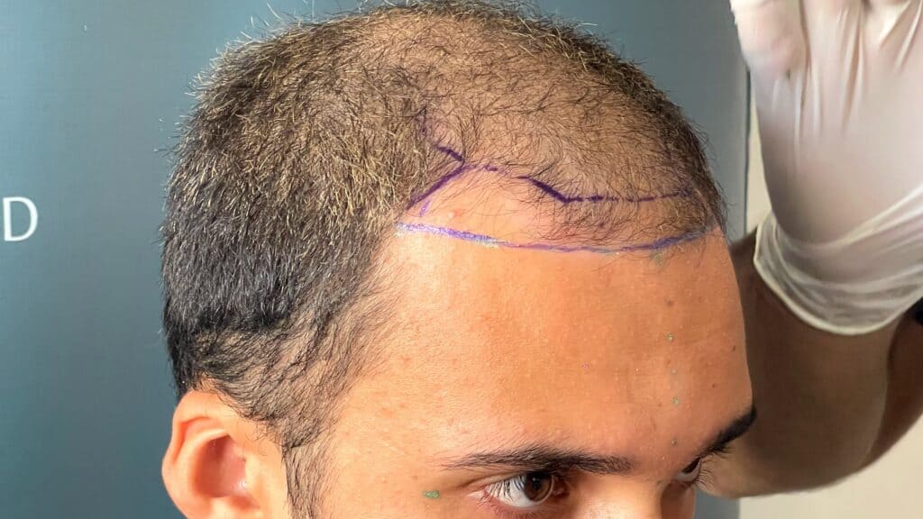 4500 grafts hair transplant