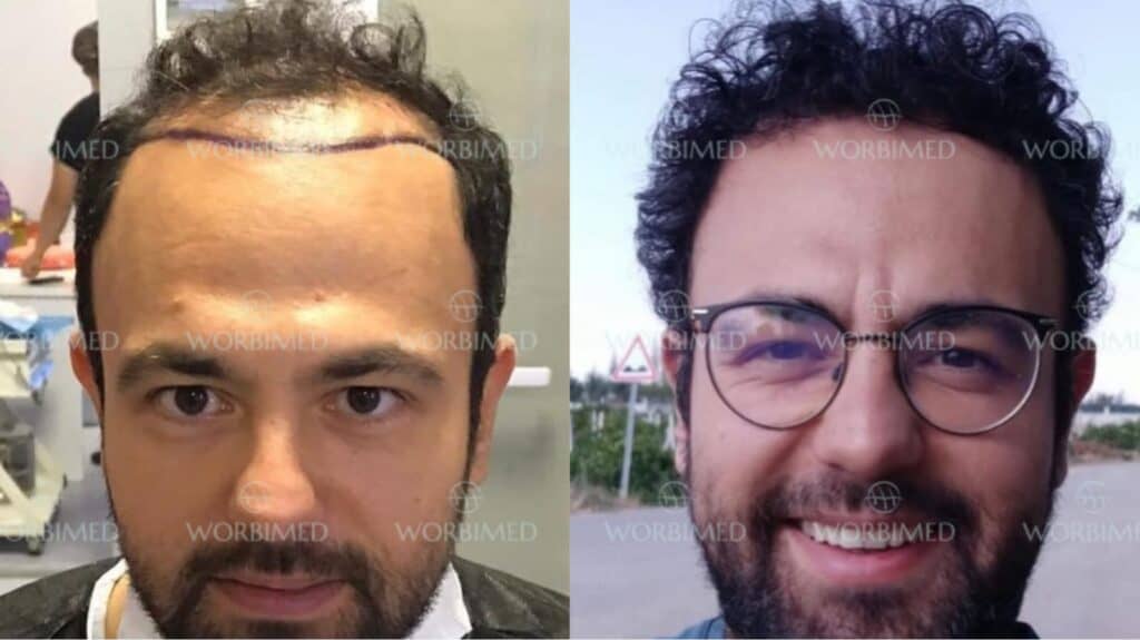 4500 grafts hair transplant result