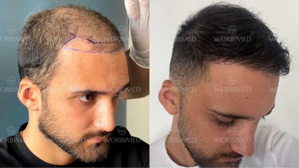 4500 grafts hair transplant result