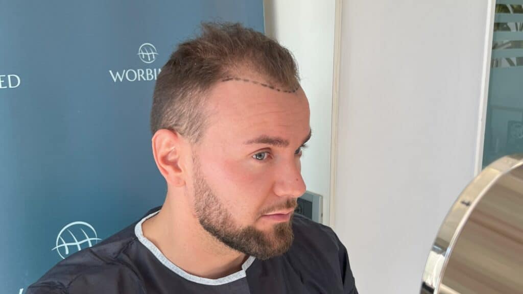 4500 grafts hair transplant in Turkey