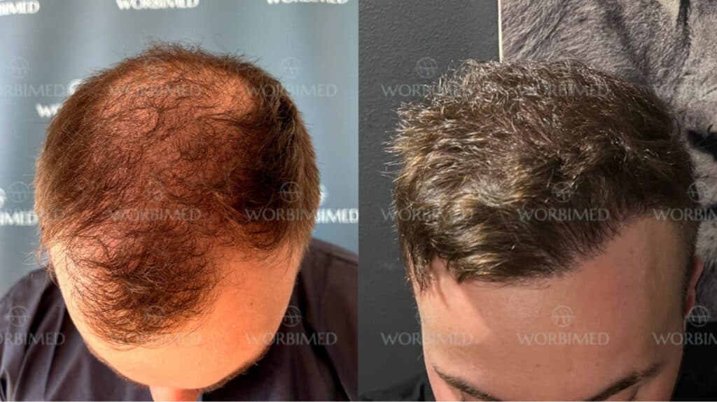 4500 grafts hair transplant result