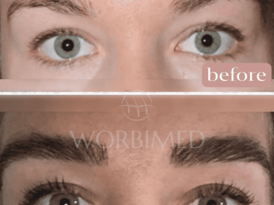 Eyebrow Transplant in Turkey