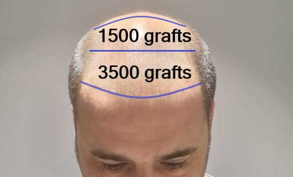 5000 grafts hair transplant