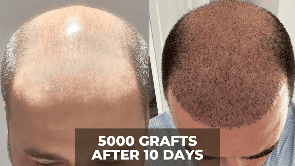 What do 5000 grafts look like?