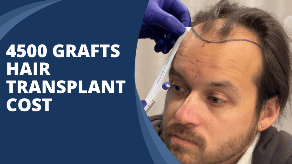 4500 grafts hair transplant cost