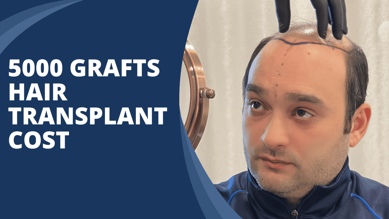 How much does a 5000 grafts hair transplant cost?