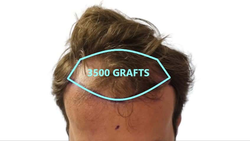 How much area can 3500 grafts cover