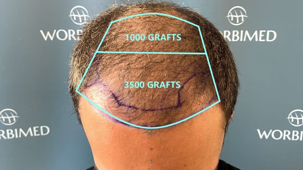 How much area can 4500 grafts cover