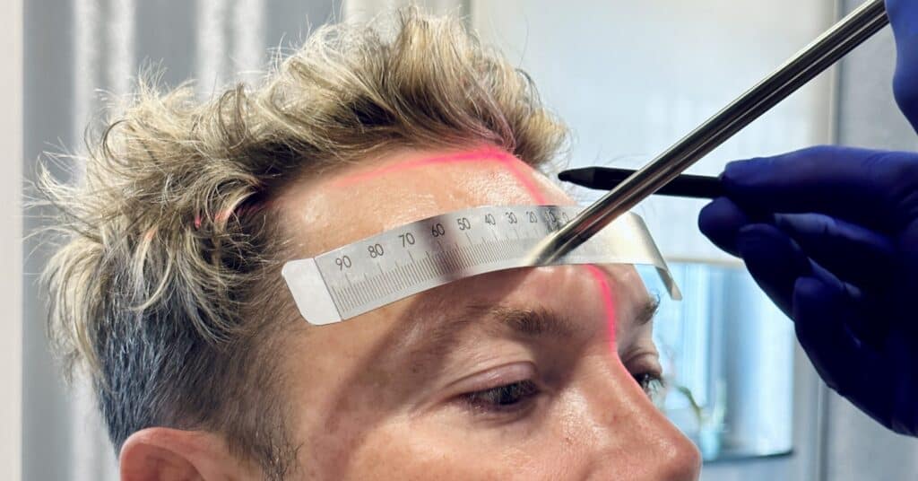 2000 grafts hair transplant