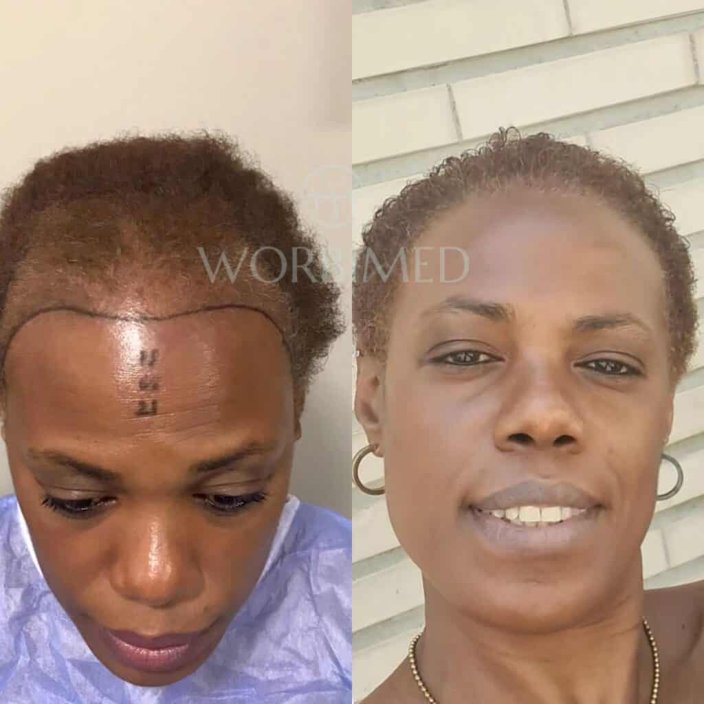 Black women hair transplant before and after result