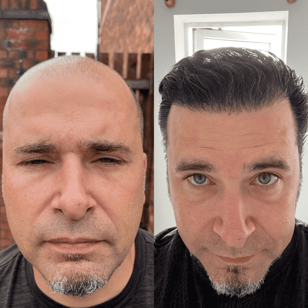 5000 Grafts Hair Transplant before after results