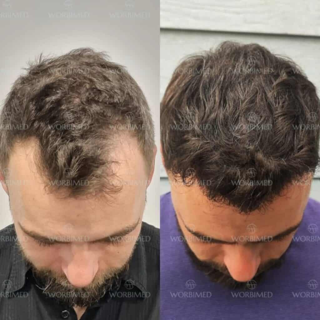 3000 grafts hair transplant before and after 