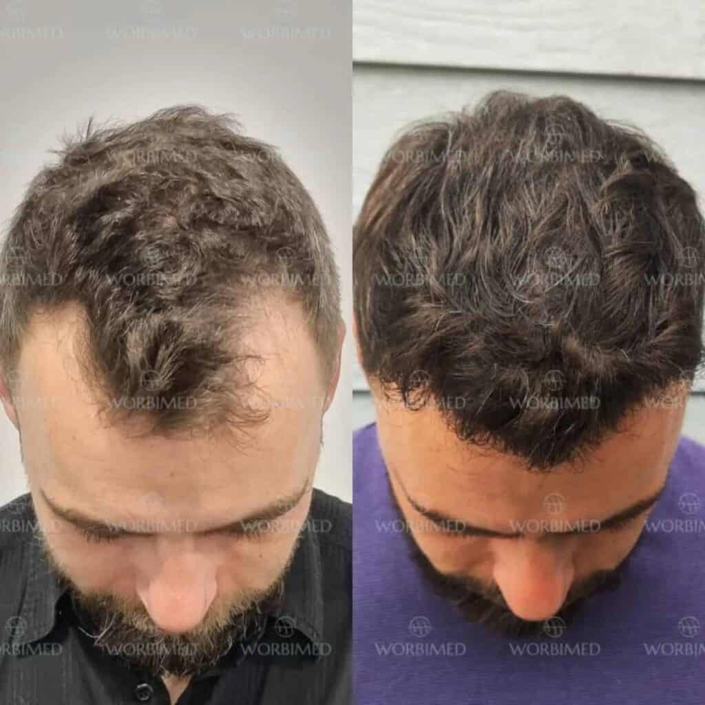 Пересадка волос 3000 графтов до и после
