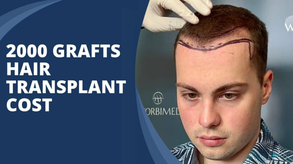 2000 grafts hair transplant cost