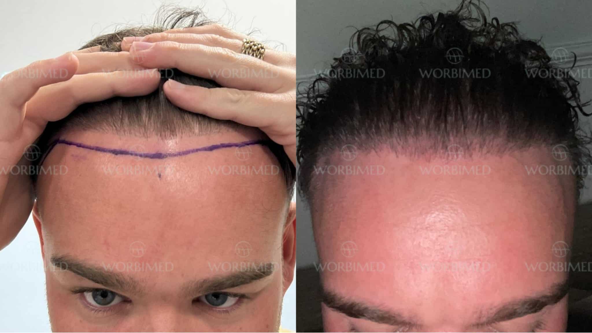 2000 grafts hair transplant before and after