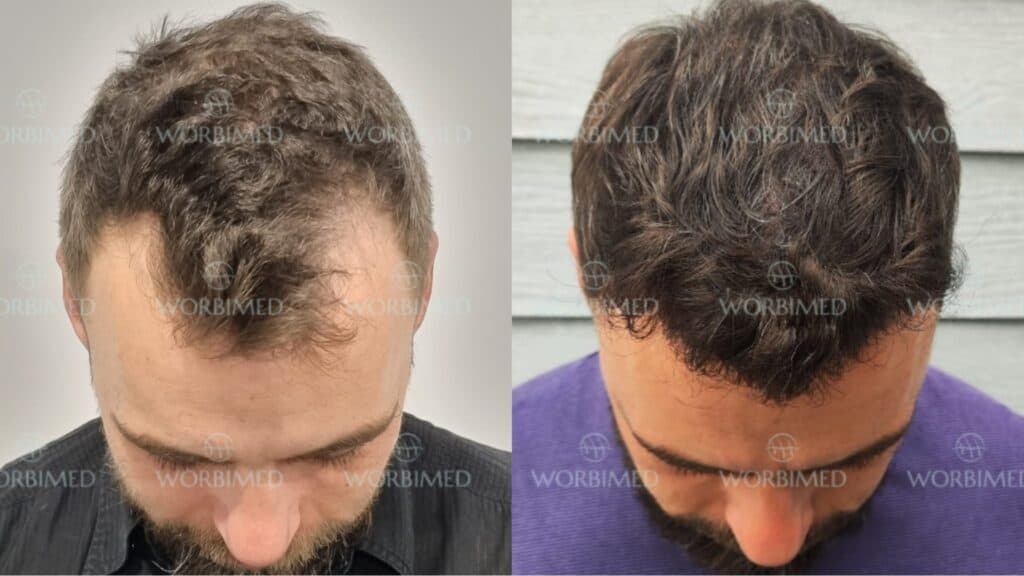 Hair transplant Turkey reviews