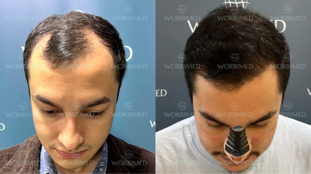 hair transplant reviews turkey