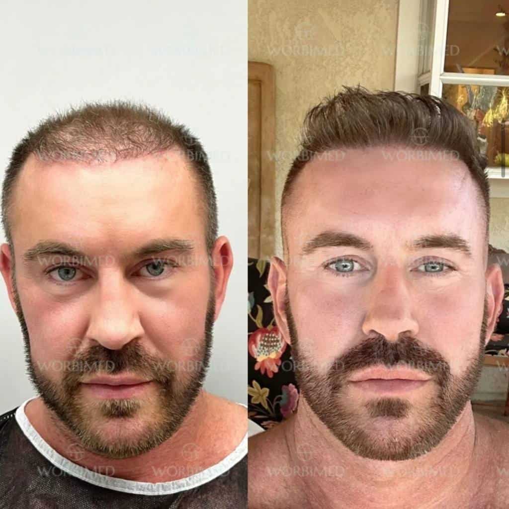 4000 grafts hair transplant before and after results