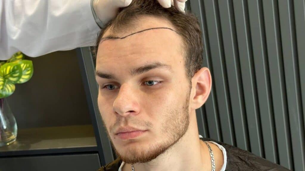 4000 grafts hair transplant