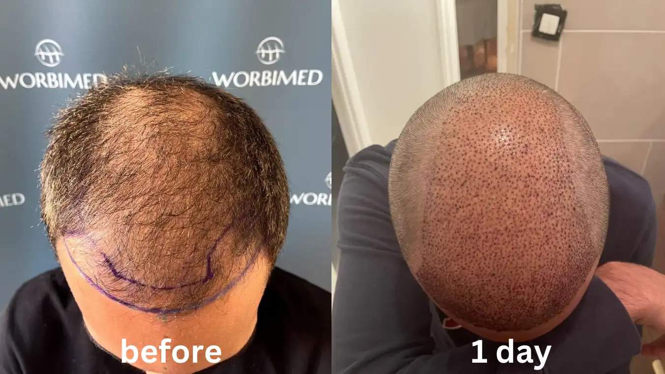 1 day after hair transplant