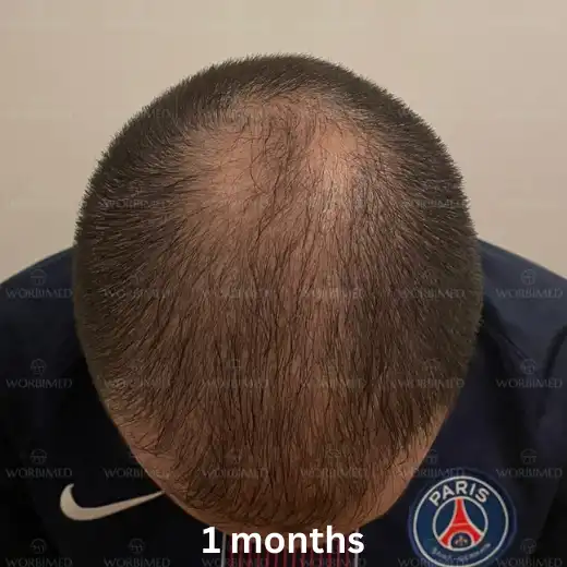 1 month after hair transplant