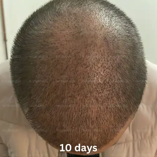 10 days after hair transplant