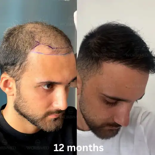 12 months after hair transplant result