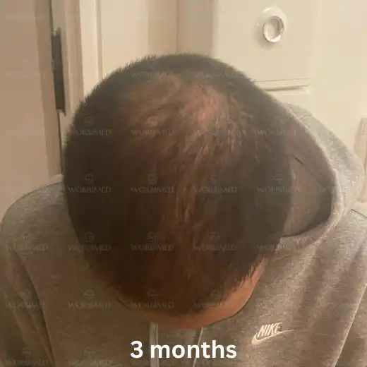 3 months after hair transplant