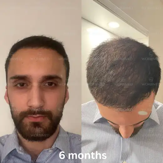 6 months after hair transplant