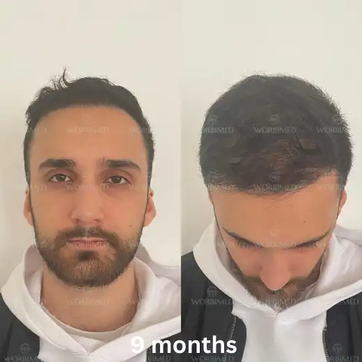 9 months after hair transplant