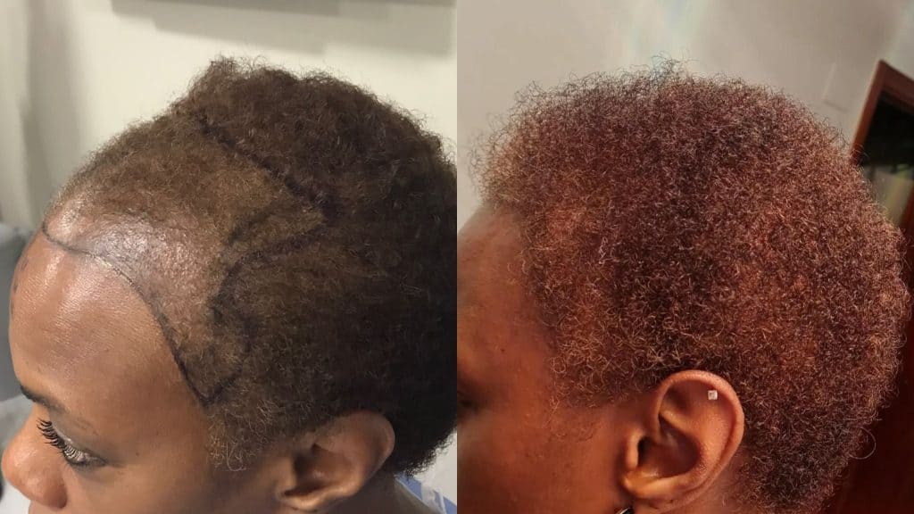 Black women hair transplant before and after