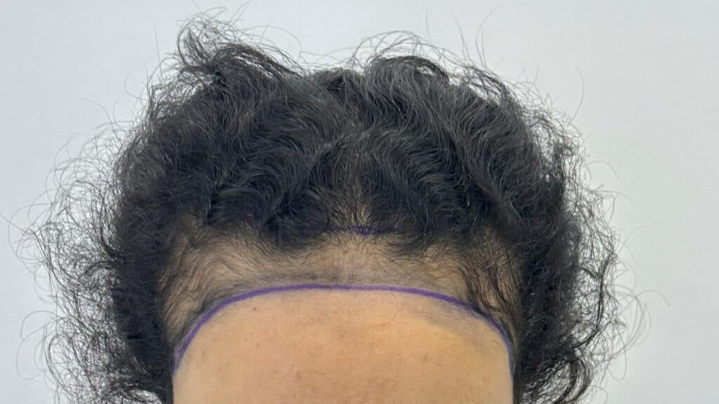 Female unshaven hair transplant 